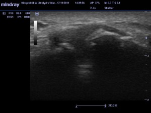 ultralydsscanning af skulderen, scanning af skulder, artrose ac-leddet, slidgigt i skulder, ultralydsscanning frederiksberg, ultralydsscanning københavn, scanning uden henvisning