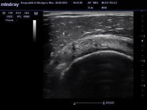 Supraspinatus-tendinopati, ultralyd af skulder, ultralydsscanning skulder, eksempler på ultralydsscanning, scanning uden henvisning