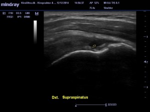 Ruptur supraspinatus rotator cuff